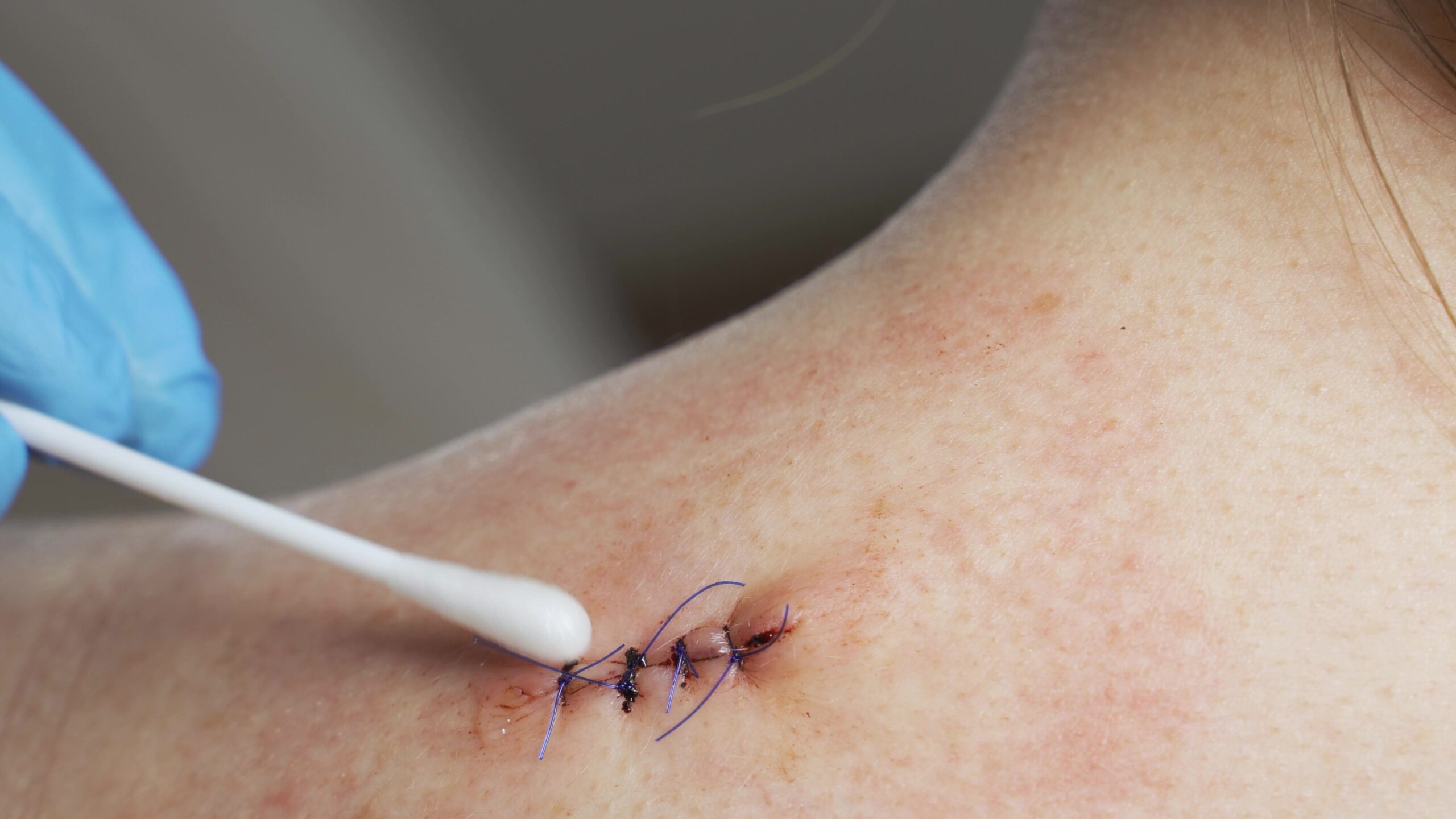 A doctor treats a wound on a woman's shoulder. Consequences of breast surgery, laparoscopy.